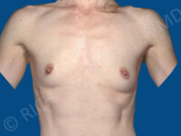 before breast augmentation front view case 3410