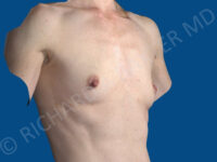 before breast augmentation angle view case 3410