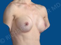 after breast augmentation angle view case 3410