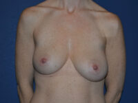 before breast augmentation front view case 3425