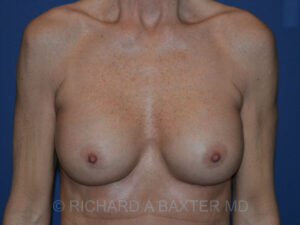 after breast augmentation front view case 3430