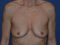before breast augmentation front view case 3430