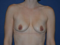 before breast augmentation front view case 3435