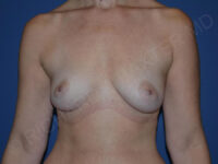 before breast augmentation front view case 3443
