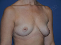 before breast augmentation angle view case 3443