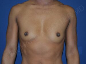 before breast augmentation front view case 3448
