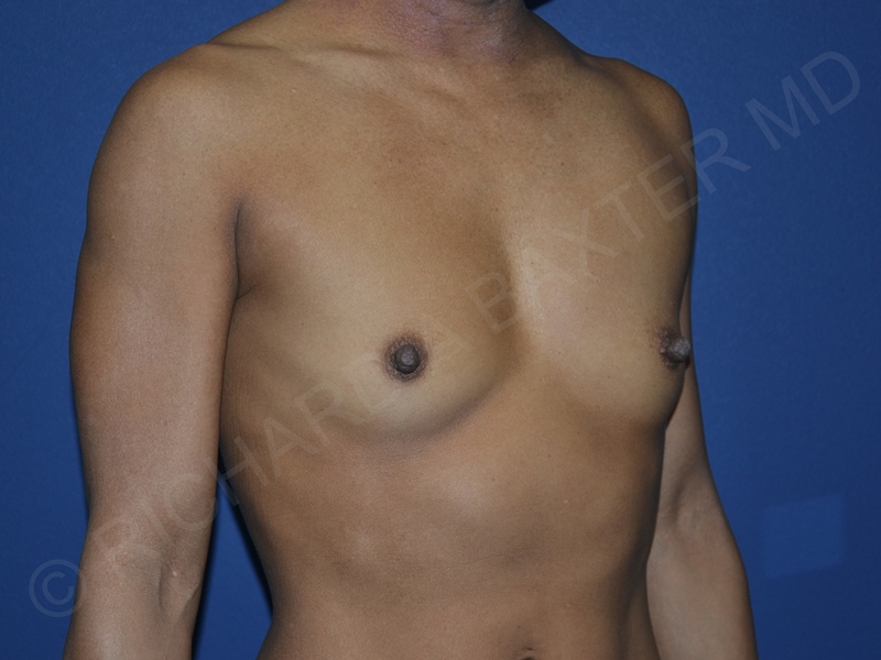 before breast augmentation angle view case 3448