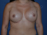 after breast augmentation front view case 3453