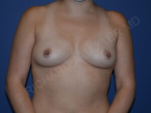 before breast augmentation front view case 3453
