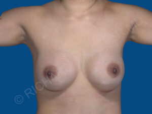 after breast augmentation front view case 3458