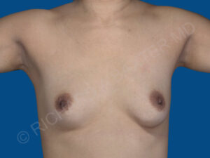 before breast augmentation front view case 3458