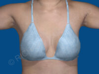 after breast augmentation front view with top case 3458