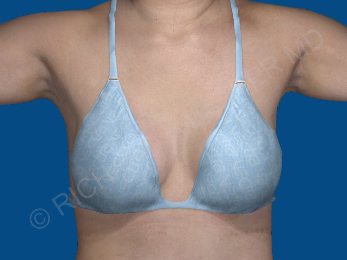 after breast augmentation front view with top case 3458