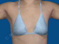 before breast augmentation front with top view case 3458