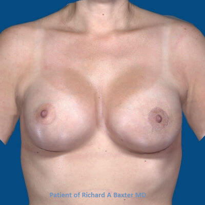 after breast augmentation front view case 3465