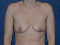 before breast augmentation front view case 3468