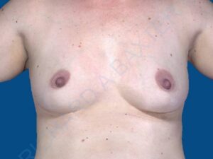 before breast augmentation front view case 3440
