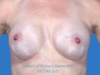 after breast augmentation front view case 3305