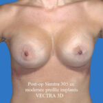after breast augmentation front view case 3298