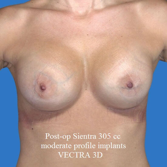 after breast augmentation front view case 3298