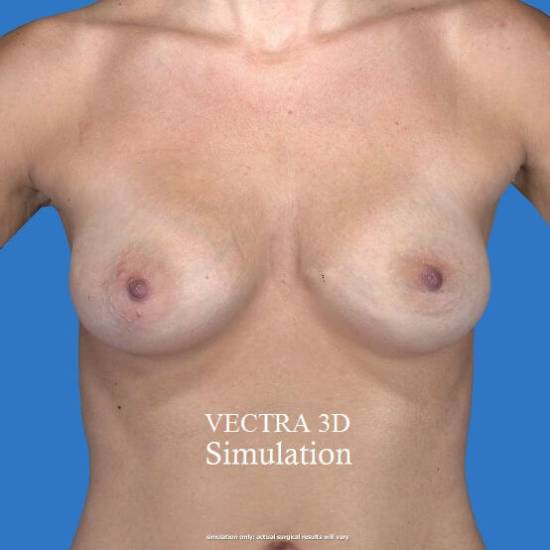 after breast augmentation front view case 3298