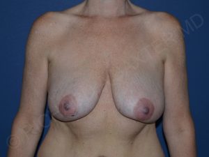 before breast lift | breast lift with implants front view case 2733