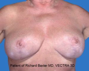 after breast lift | breast lift with implants front view case 2945