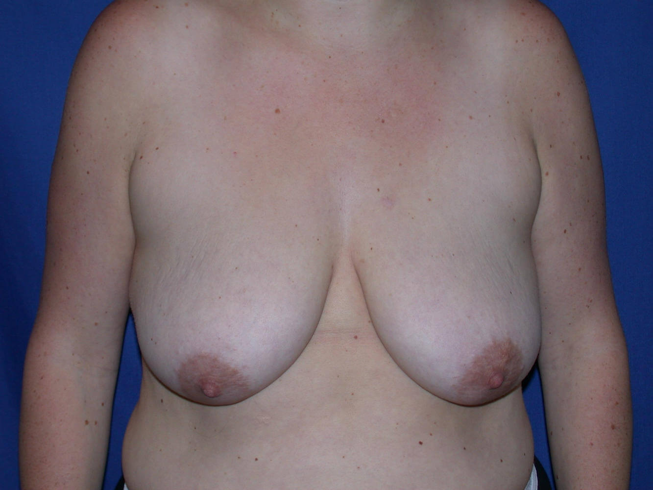 before breast lift | breast lift with implants front view case 2953