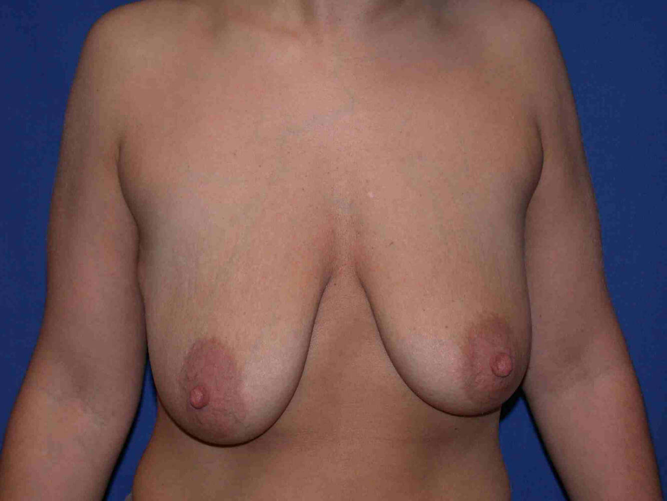 before breast lift | breast lift with implants front view case 2967