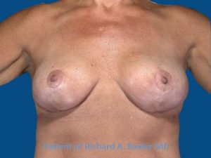 after breast lift | breast lift with implants front view case 2985