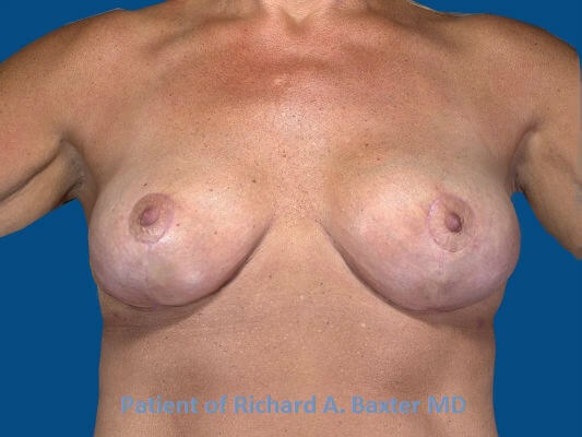 after breast lift | breast lift with implants front view case 2985