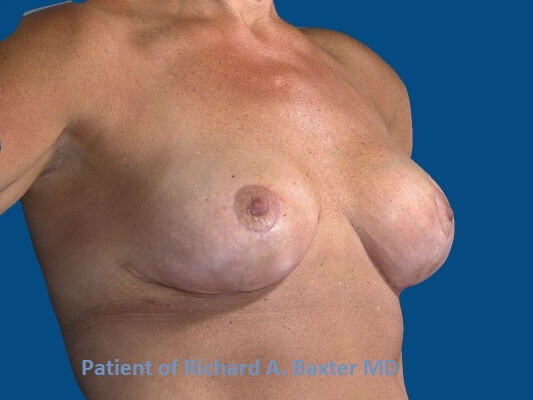 after breast lift | breast lift with implants right angled view case 2985