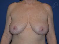 before breast lift | breast lift with implants front view case 3002