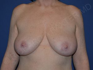 before breast lift | breast lift with implants front view case 3002