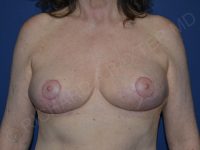 after breast lift | breast lift with implants front view case 3002