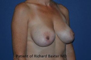 before breast lift | breast lift with implants right angled view case 3038
