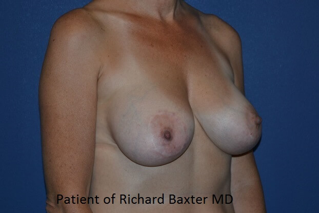 before breast lift | breast lift with implants right angled view case 3038