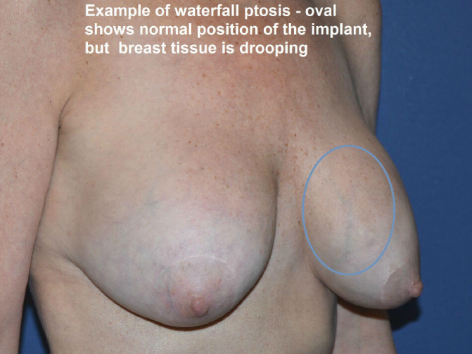 before breast lift | breast lift with implants right angle view case 2974