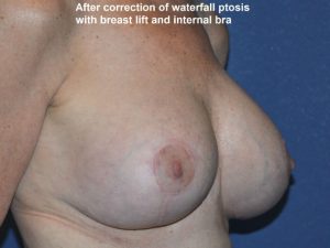 after breast lift | breast lift with implants right angle view case 2974