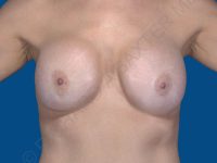 before breast lift | breast lift with implants front view case 2535