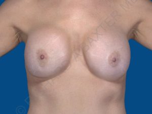 before breast lift | breast lift with implants front view case 2535