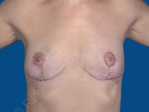 after breast lift | breast lift with implants front view case 2535