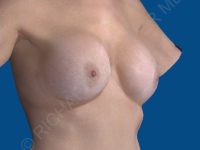 before breast lift | breast lift with implants right angle view case 2535