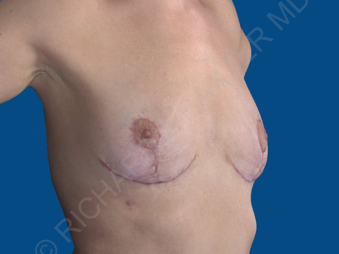 after breast lift | breast lift with implants right angle view case 2535