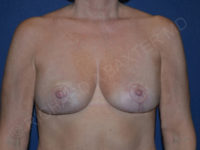 after breast lift | breast lift with implants front view case 2723