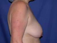 before breast lift | breast lift with implants right side view case 2953