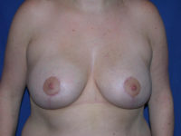 after breast lift | breast lift with implants front view case 2953