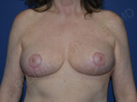 after breast lift | breast lift with implants front view case 3002