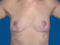 after breast lift | breast lift with implants front view case 2535