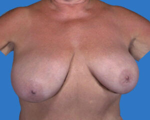 before breast lift | breast lift with implants front view case 2945